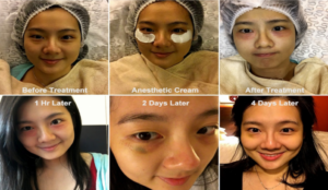 Top 2 Proven Cosmetic Surgery In Malaysia 2022 – Avoid Getting Risky Procedures!